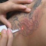 Tattoo removal can be first step in ensuring job search success
