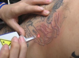 Tattoo removal can be first step in ensuring job search success - Jails to  Jobs