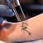 Who can operate a laser and remove tattoos? Here’s how to find that out and more